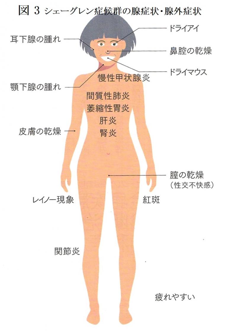 症候群 症状 シェーグレン