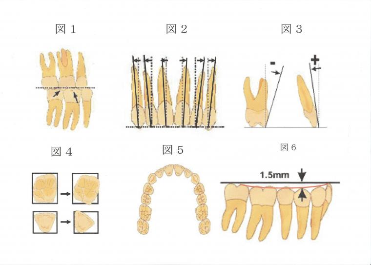 「正常咬合への6つの鍵（Andrews）」について