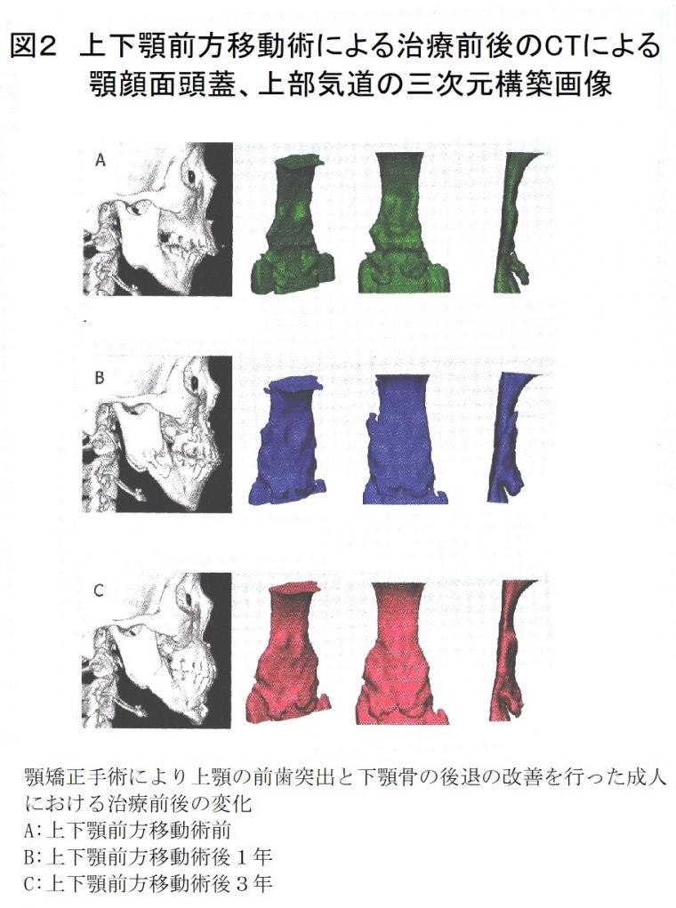 睡眠時無呼吸の一般的な治療法と矯正歯科での治療例について