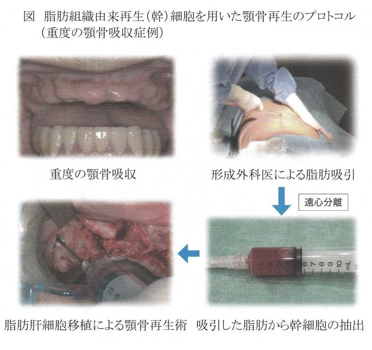 歯科における再生医療として期待される脂肪肝細胞による顎骨再生術について