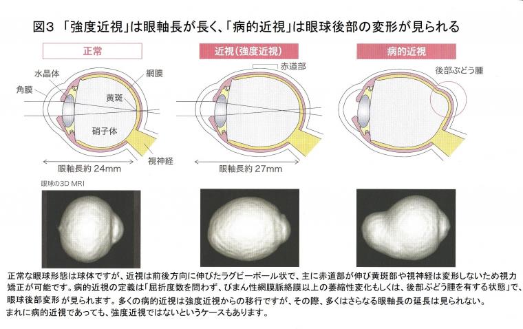 近視がもたらす重大疾患について（前編）