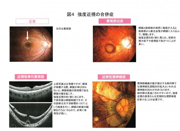 近視がもたらす重大疾患について（後編）