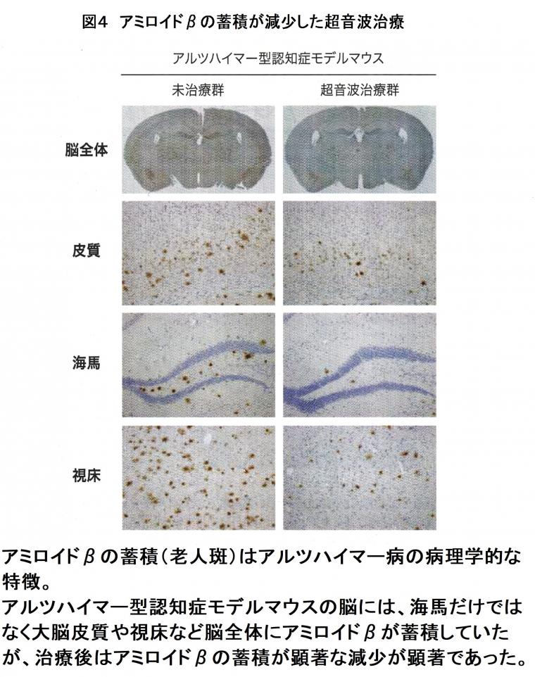 「低出力パルス波超音波治療によるアルツハイマー病への応用について（前編）」