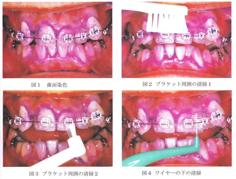 矯正装置に特有な清掃方法について