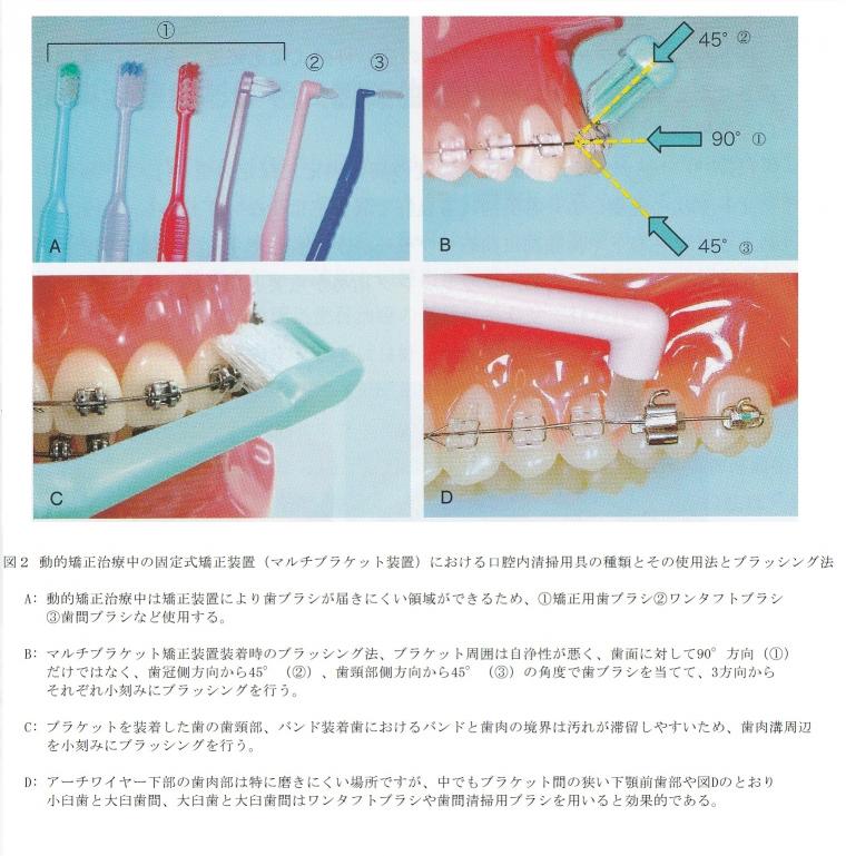 動的治療中の口腔清掃について