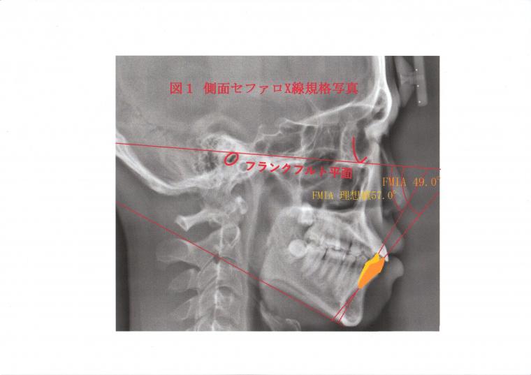 抜歯する?しない?ってどうやって決めているの?