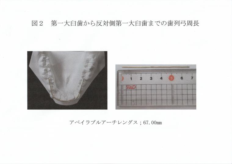 抜歯する?しない?ってどうやって決めているの?