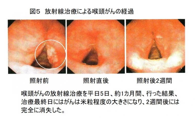 最新がん放射線治療について（前編）