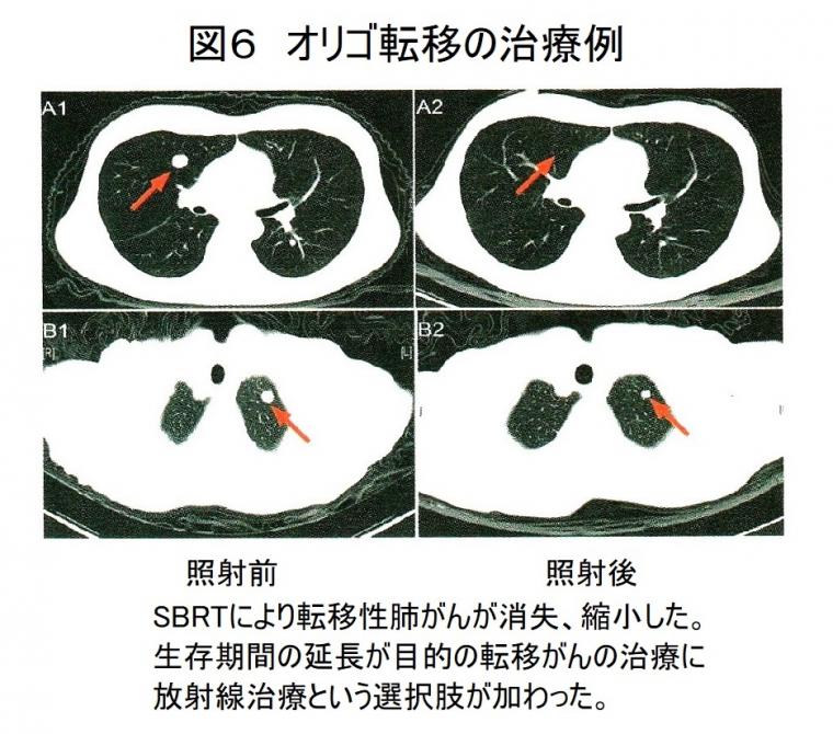 最新がん放射線治療について（後編）