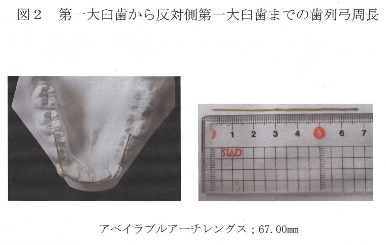 抜歯する？しない？ってどうやって決めているの？