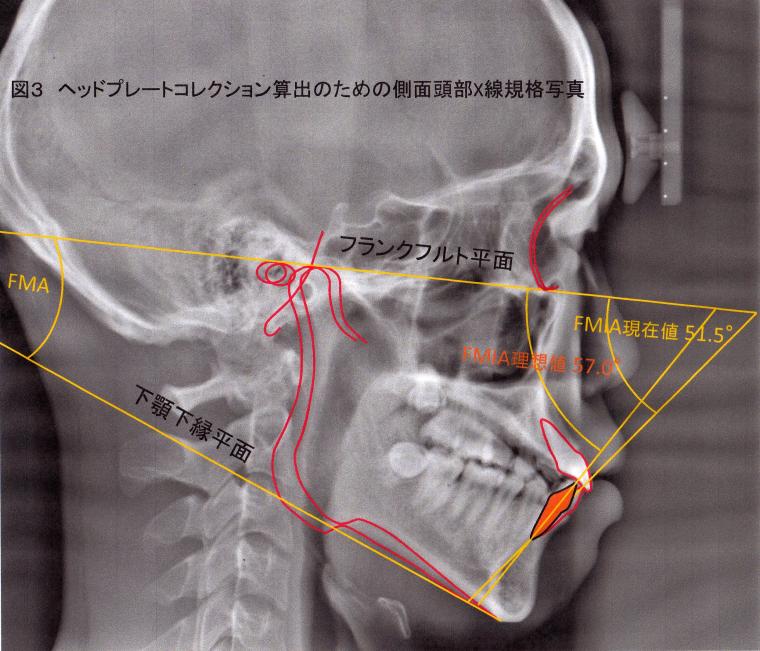 抜歯する？しない？ってどうやって決めているの？