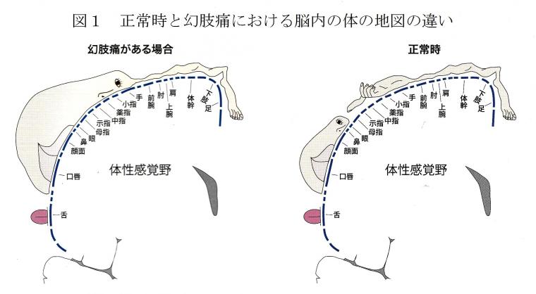 「幻肢痛」の治療に活用されるVRについて（前編）