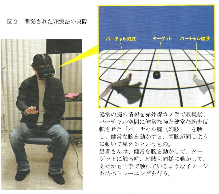 「幻肢痛」の治療に活用されるVRについて（前編）