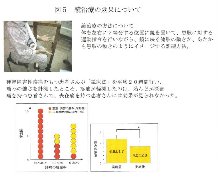 「幻肢痛」の治療に活用されるVRについて(後編)