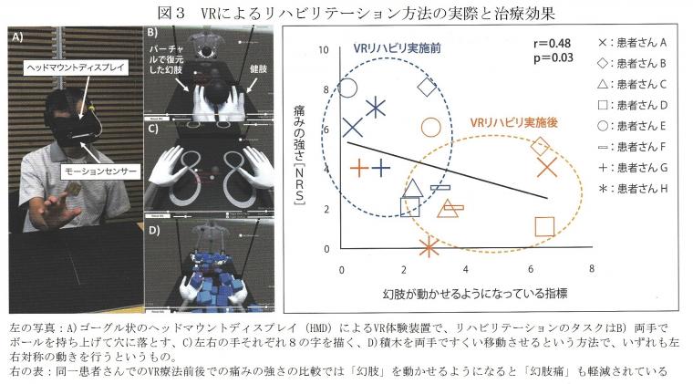 「幻肢痛」の治療に活用されるVRについて（前編）