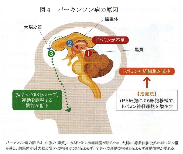 iPS細胞を利用したパーキンソン病の治験について（前編）