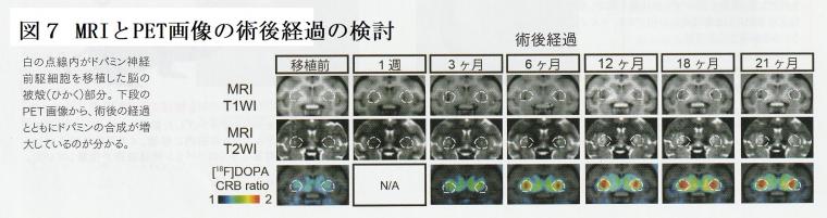 iPS細胞を利用したパーキンソン病の治験について（前編）